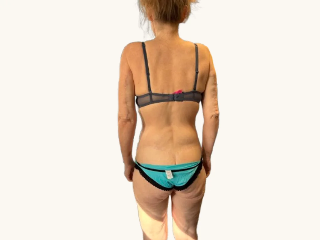 Arm lift after, back view, showing healed arms