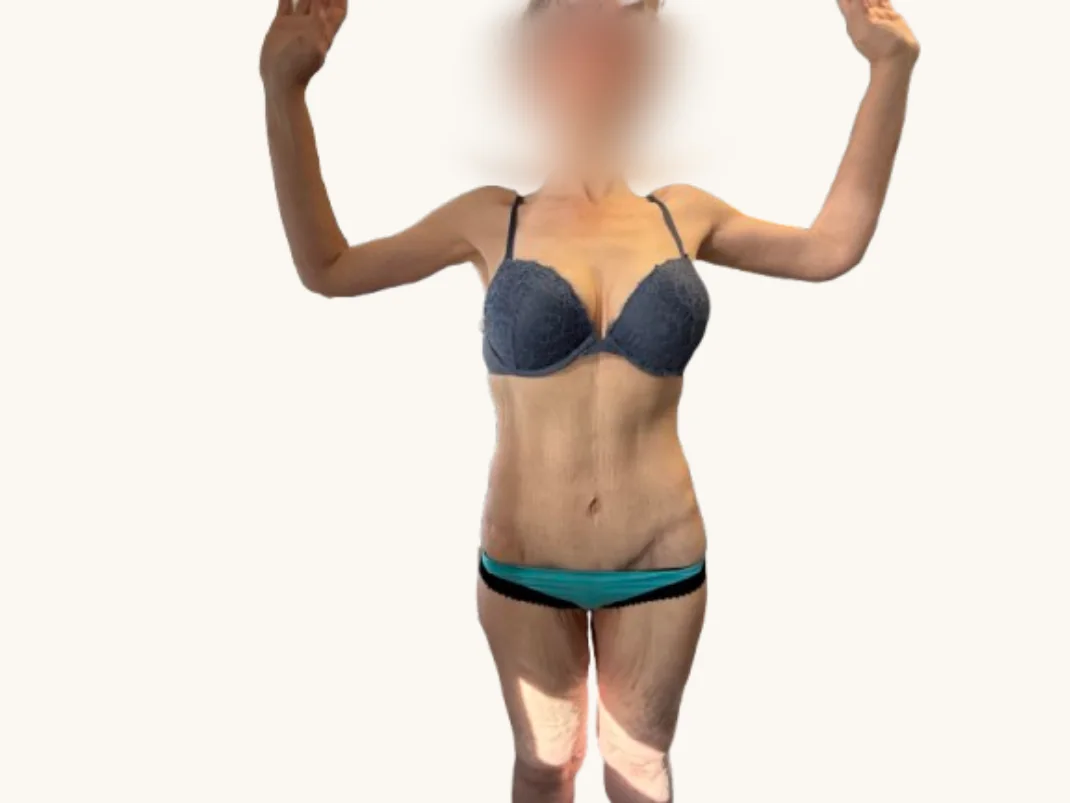 Arm lift after, front view, showing healed arms