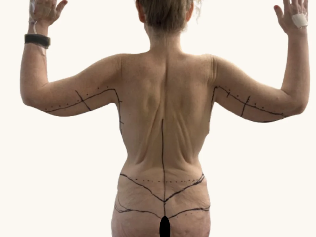 Arm lift before, back view, showing pre-operative surgical markings