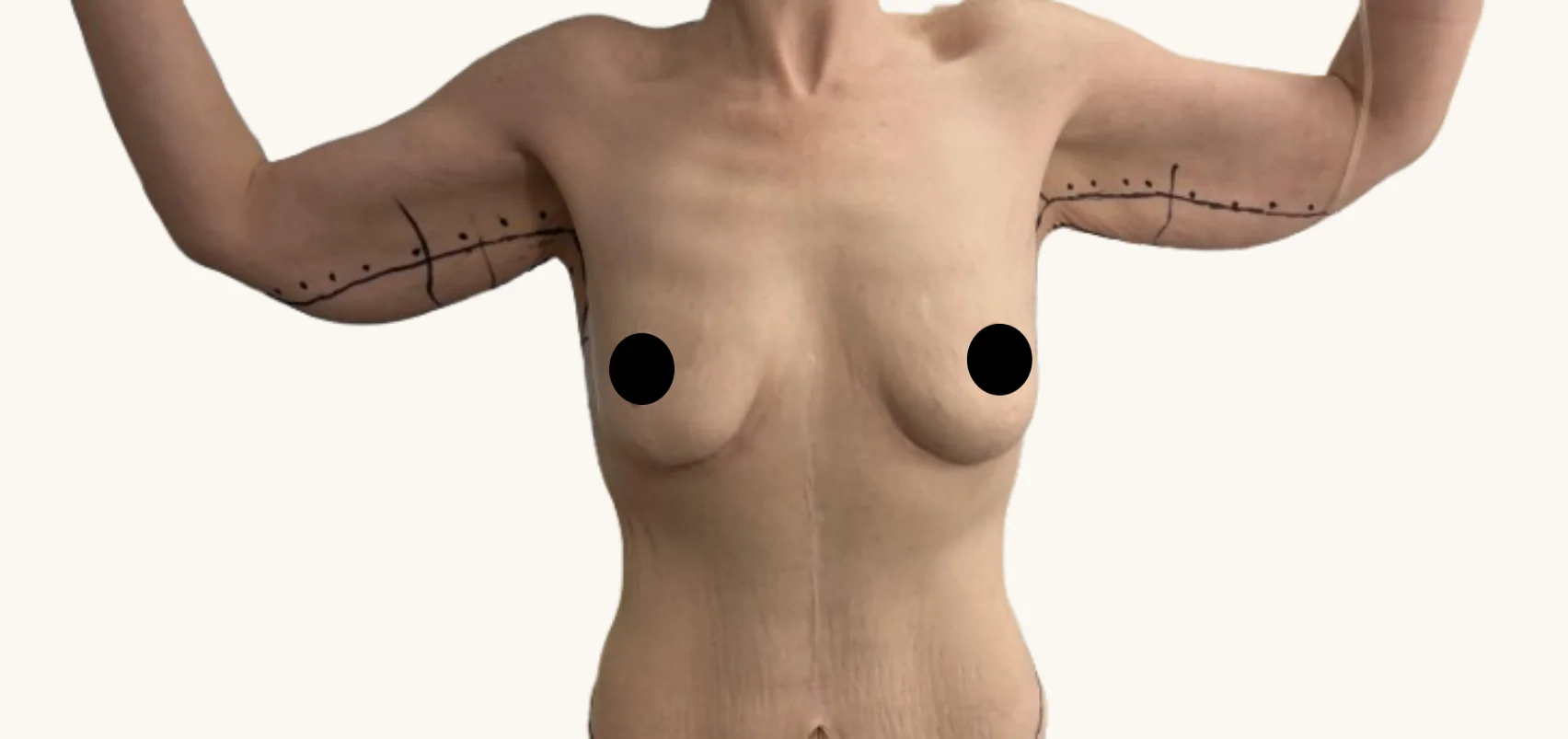 Arm lift before, front view, showing pre-operative surgical markings