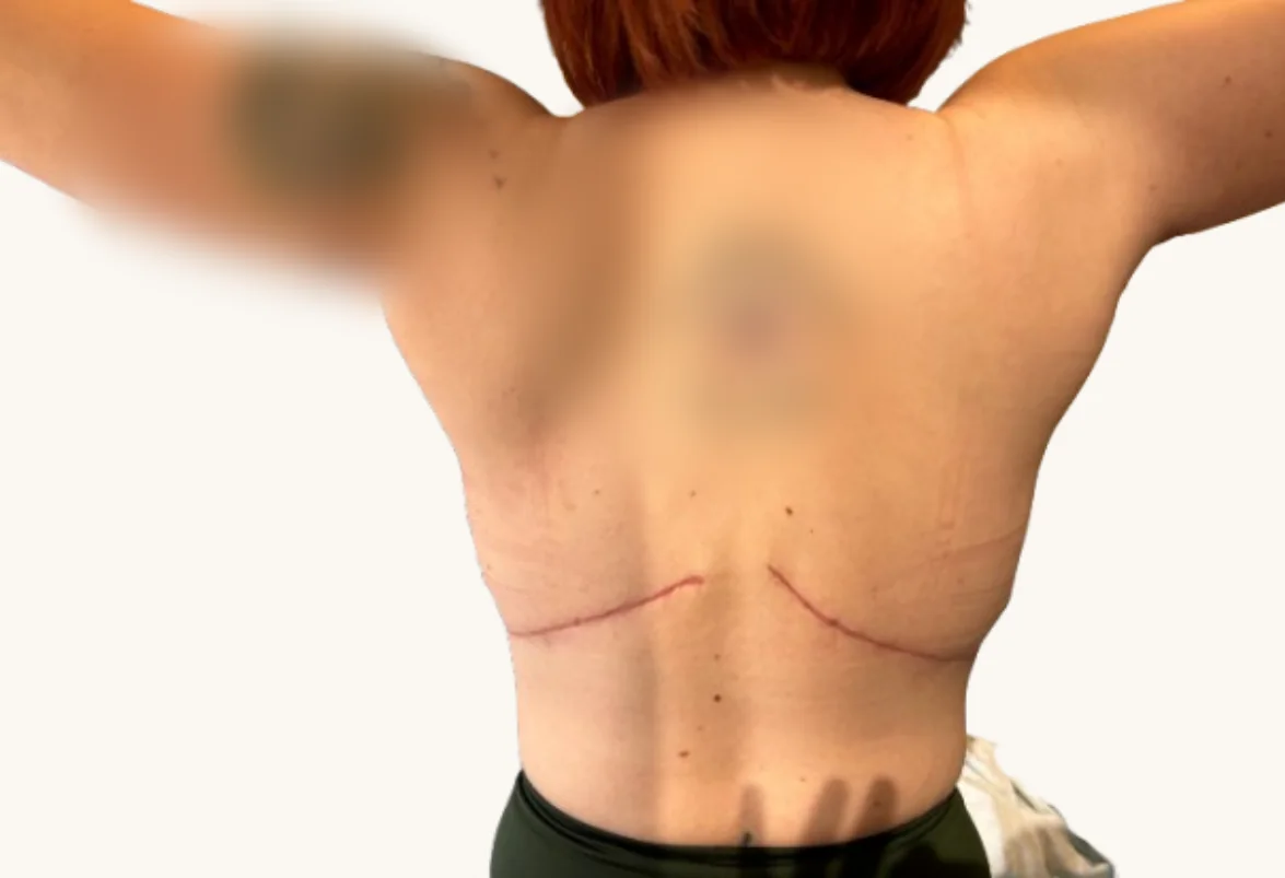 Bra line back lift after, showing healed back-lift scar