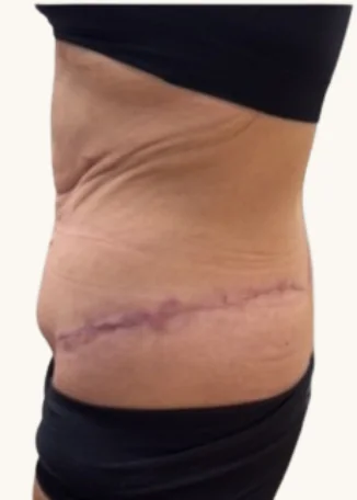 Body lift after, side view, showing healed circumferential incision