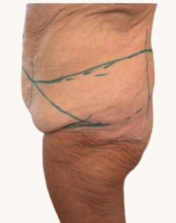 Body lift before, side view, showing pre-operative circumferential surgical markings