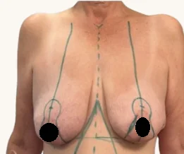 Breast lift with augmentation before, front view, showing pre-operative surgical markings