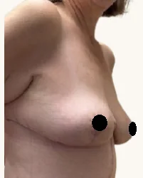 Breast lift with augmentation after, side view, showing healed result