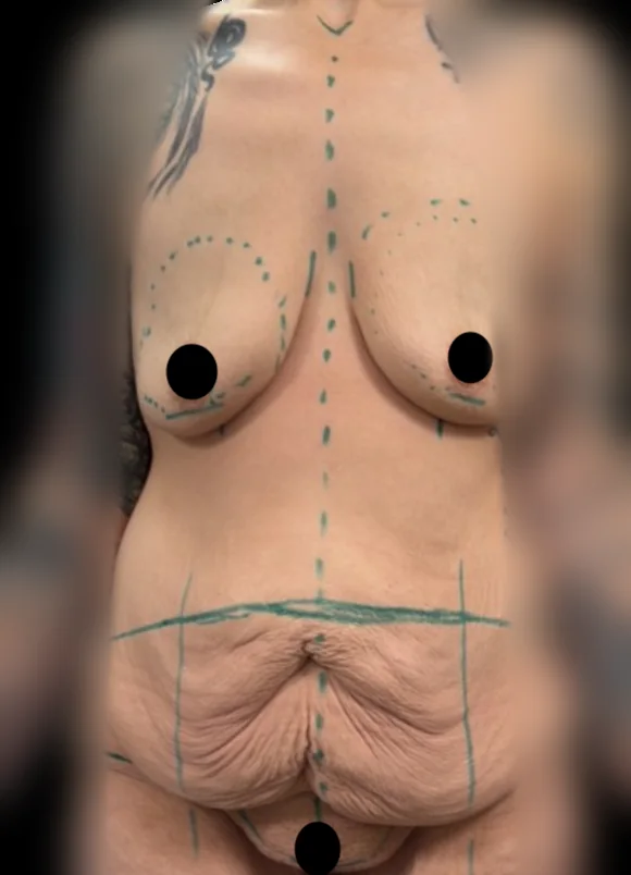 Mommy makeover before, front view, showing pre-operative surgical markings for combined abdominoplasty and breast augmentation