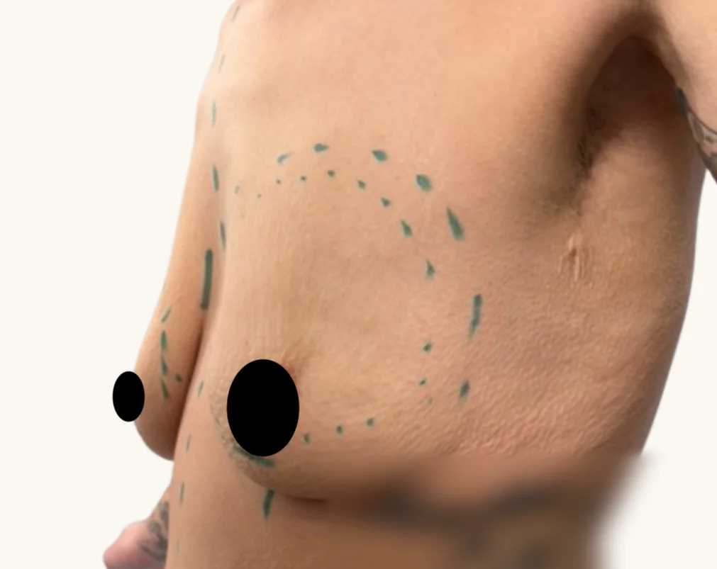 Breast augmentation before, side view, showing pre-operative surgical markings