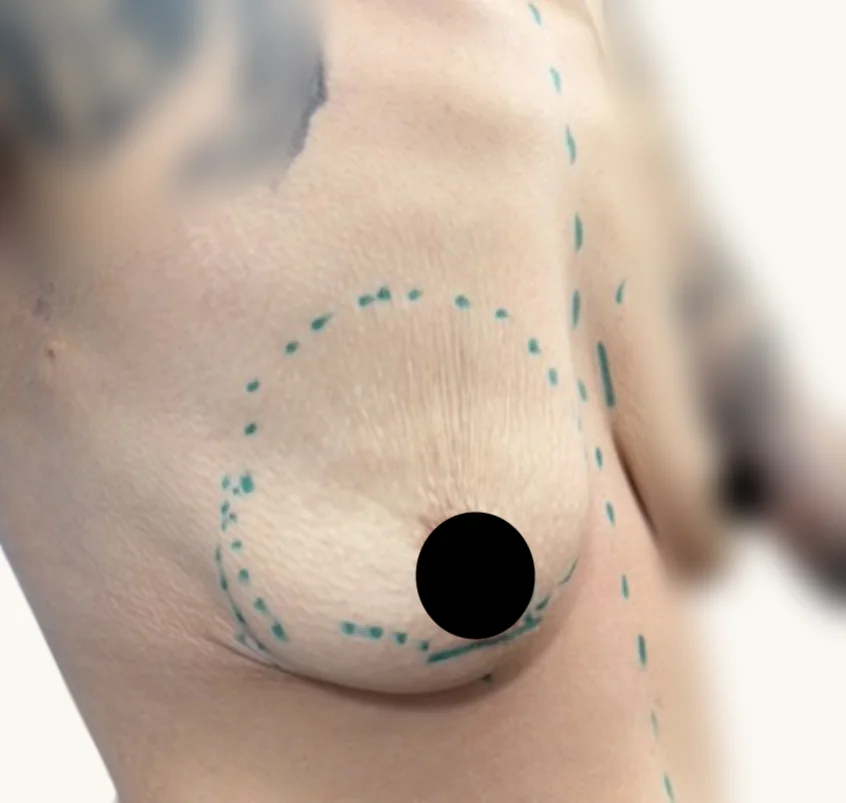 Breast augmentation before, oblique view, showing pre-operative surgical markings