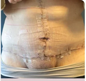 Fleur-de-lys abdominoplasty after, showing healed horizontal and vertical incision