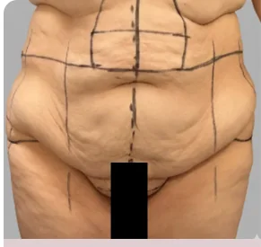 Fleur-de-lys abdominoplasty before, showing pre-operative surgical markings