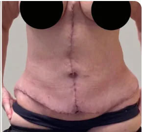 Fleur-de-lys abdominoplasty after, second patient, showing healed horizontal and vertical incision