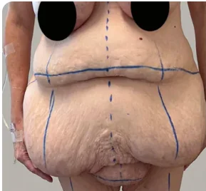 Fleur-de-lys abdominoplasty before, second patient, showing pre-operative surgical markings