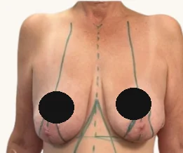 Mastopexy before, showing pre-operative surgical markings