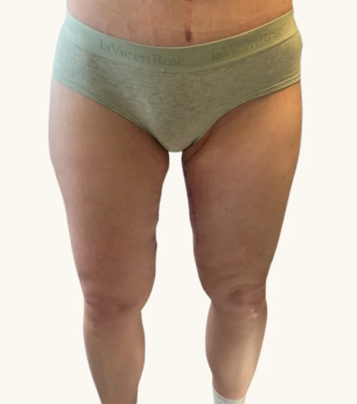 Thigh lift after, front view, showing healed inner thighs