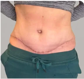 Tummy tuck after, showing healed abdomen with incision