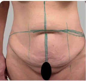 Tummy tuck before, showing pre-operative surgical markings